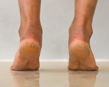 This Is The Cause Of Cracked Heels And How To Treat Them
